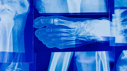 What are Stress Fractures and How to Remedy Them