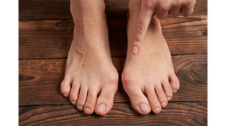 Is your Footwear Giving you Bunions?