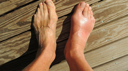 How to Find Relief from Gout