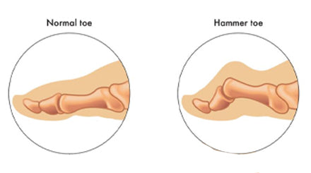 Causes of Hammer Toes